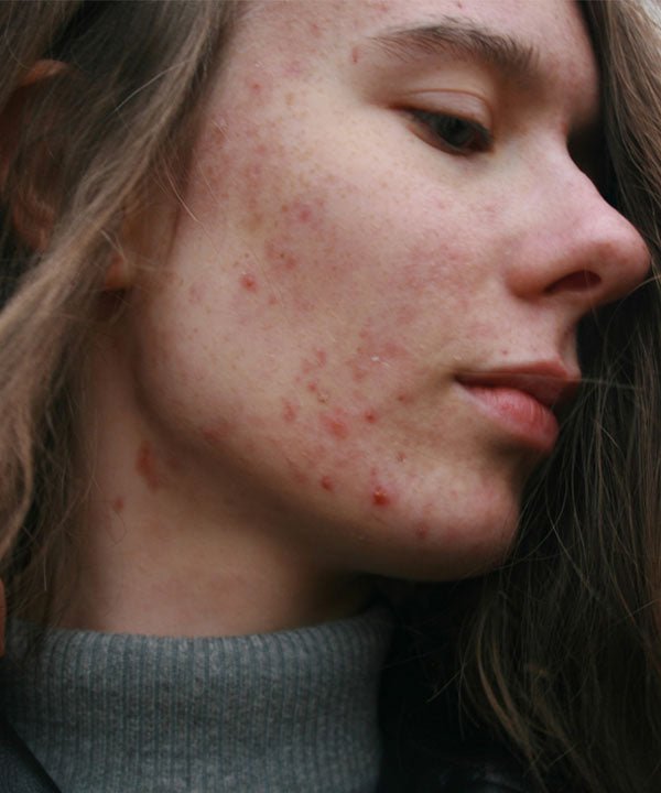 3 Hormone Related Skin Concerns. 3 Naturopathic Solutions.