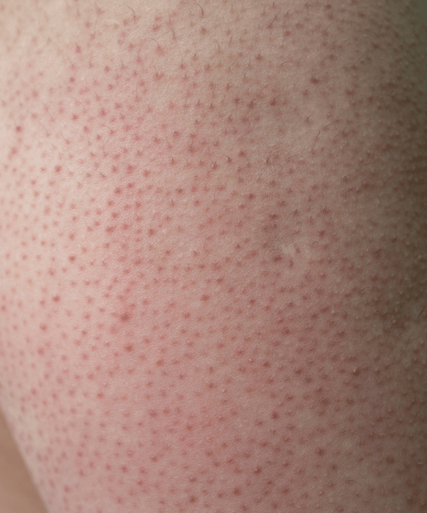 Keratosis Pilaris (KP): A Natural Approach to Smoother Skin