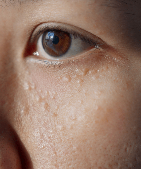Milia: What Are They and How to Treat Them Naturally