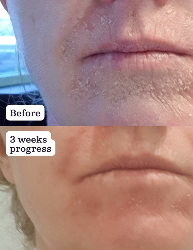 Perioral Dermatitis: Understanding and Managing Naturally