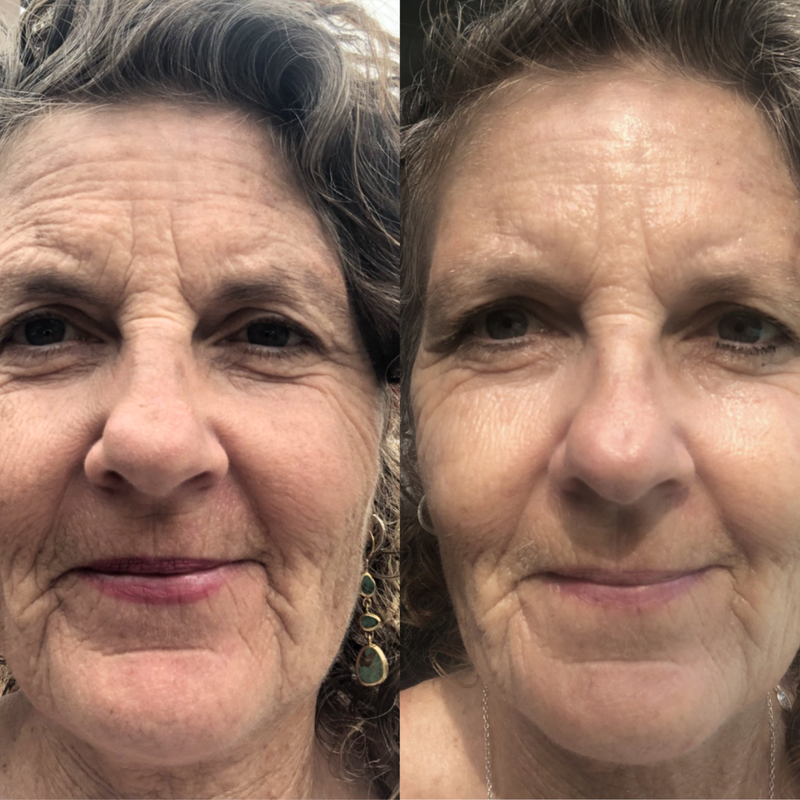 "Plumper skin in weeks"